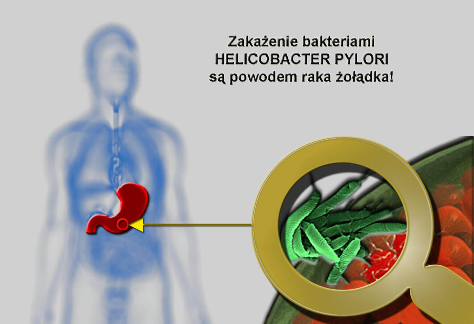 Infekcja Helicobacter Pylori Icd 10 Infekcja bakterią Helicobacter Pylori – Centrum Medycyny Naturalnej